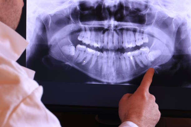 Best Emergency Wisdom Tooth Extraction in Penn Valley, CA
